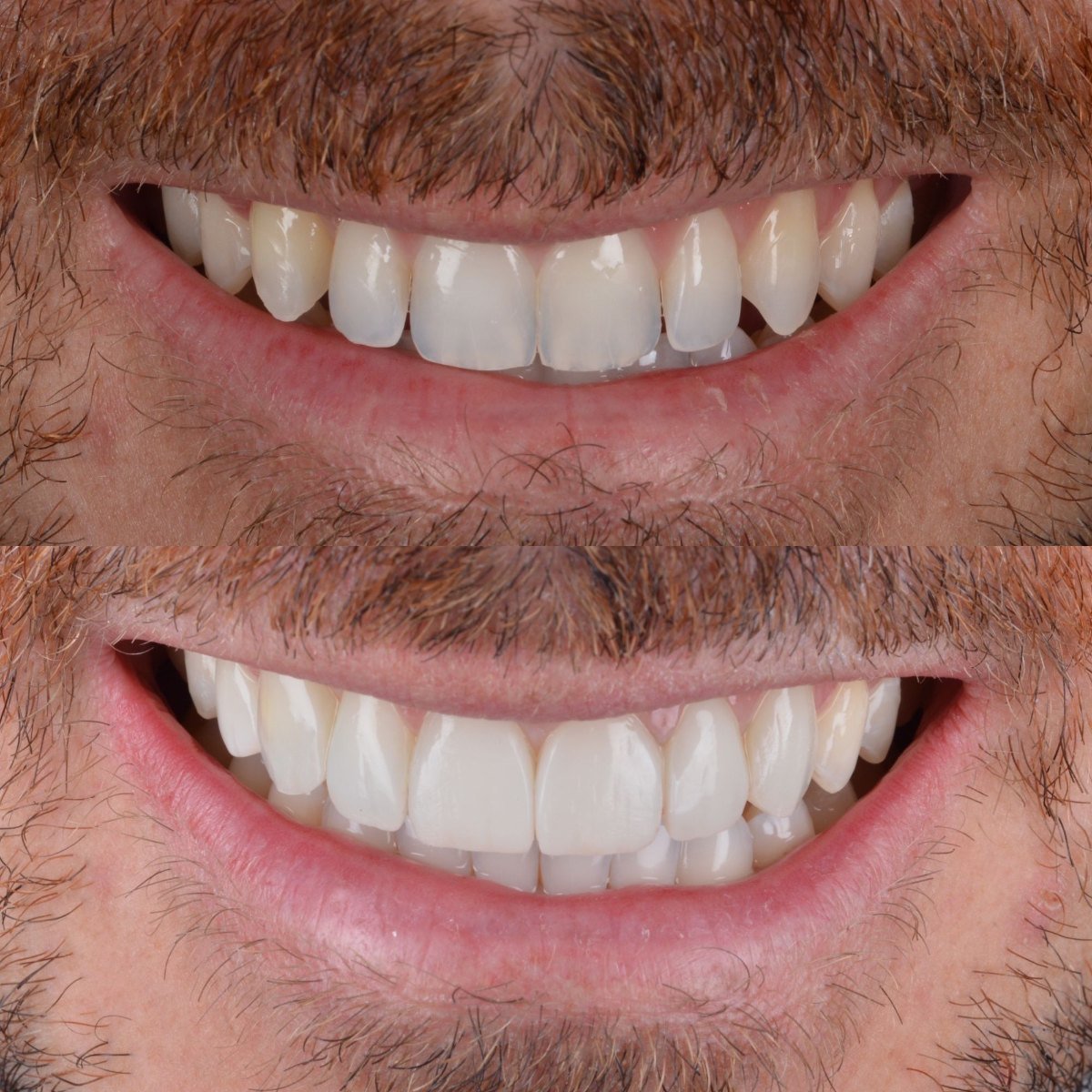 8 Composite Veneers before and after — patient of Dr Bikram Narang, cosmetic dentist in Maidenhead