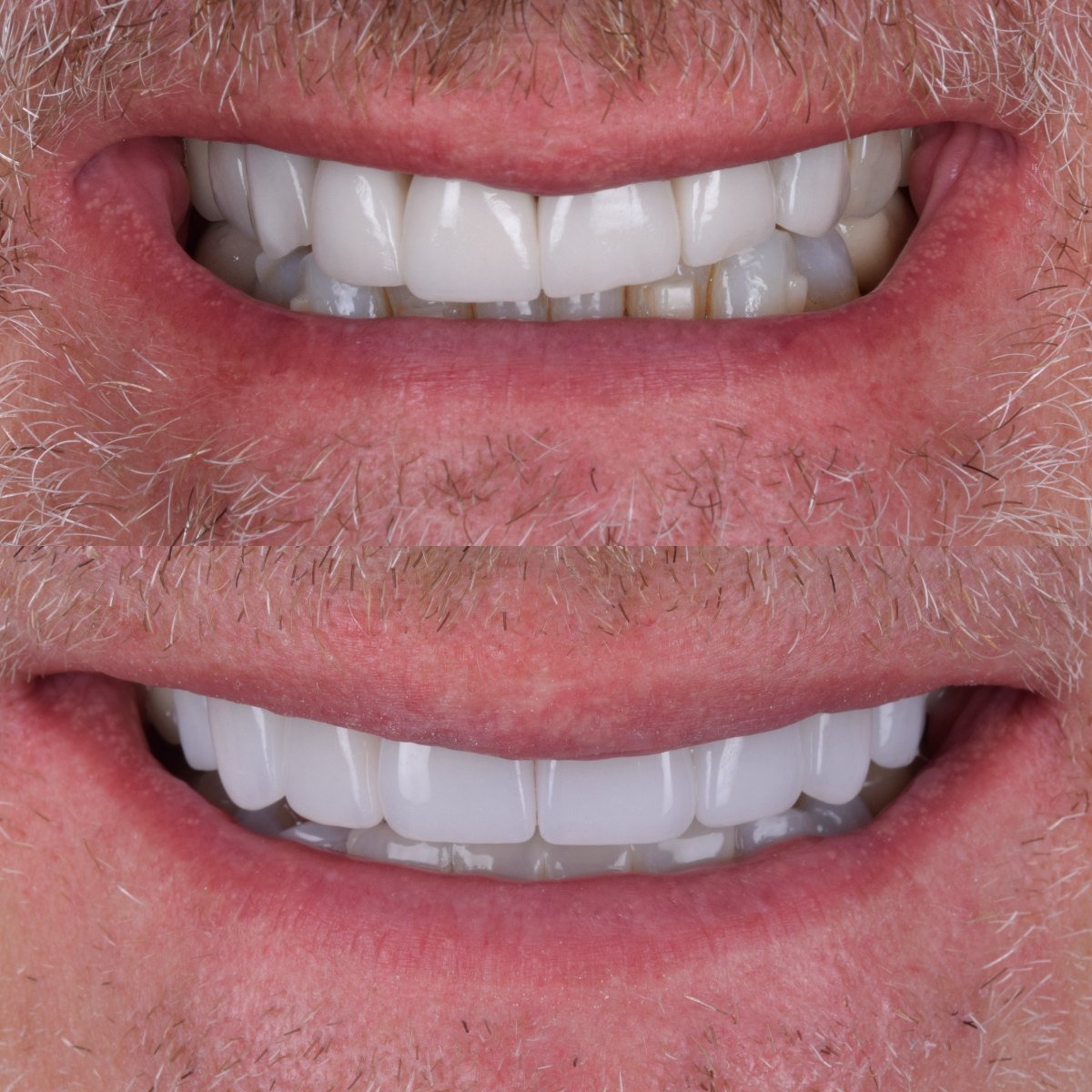8 Zirconia Crowns before and after — patient of Dr Bikram Narang, cosmetic dentist in Maidenhead