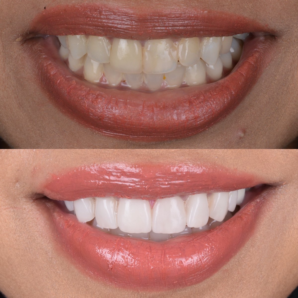 8 Porcelain Veneers before and after — patient of Dr Bikram Narang, cosmetic dentist in Maidenhead