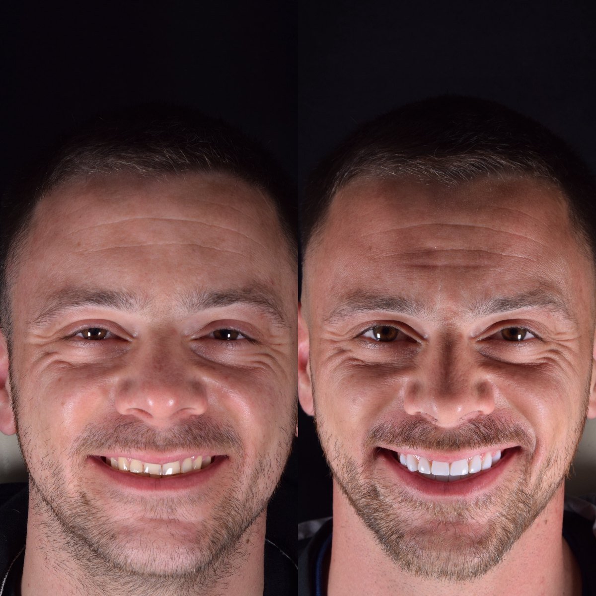 16 Composite Veneers — Tooth Wear before and after — patient of Dr Bikram Narang, cosmetic dentist in Maidenhead