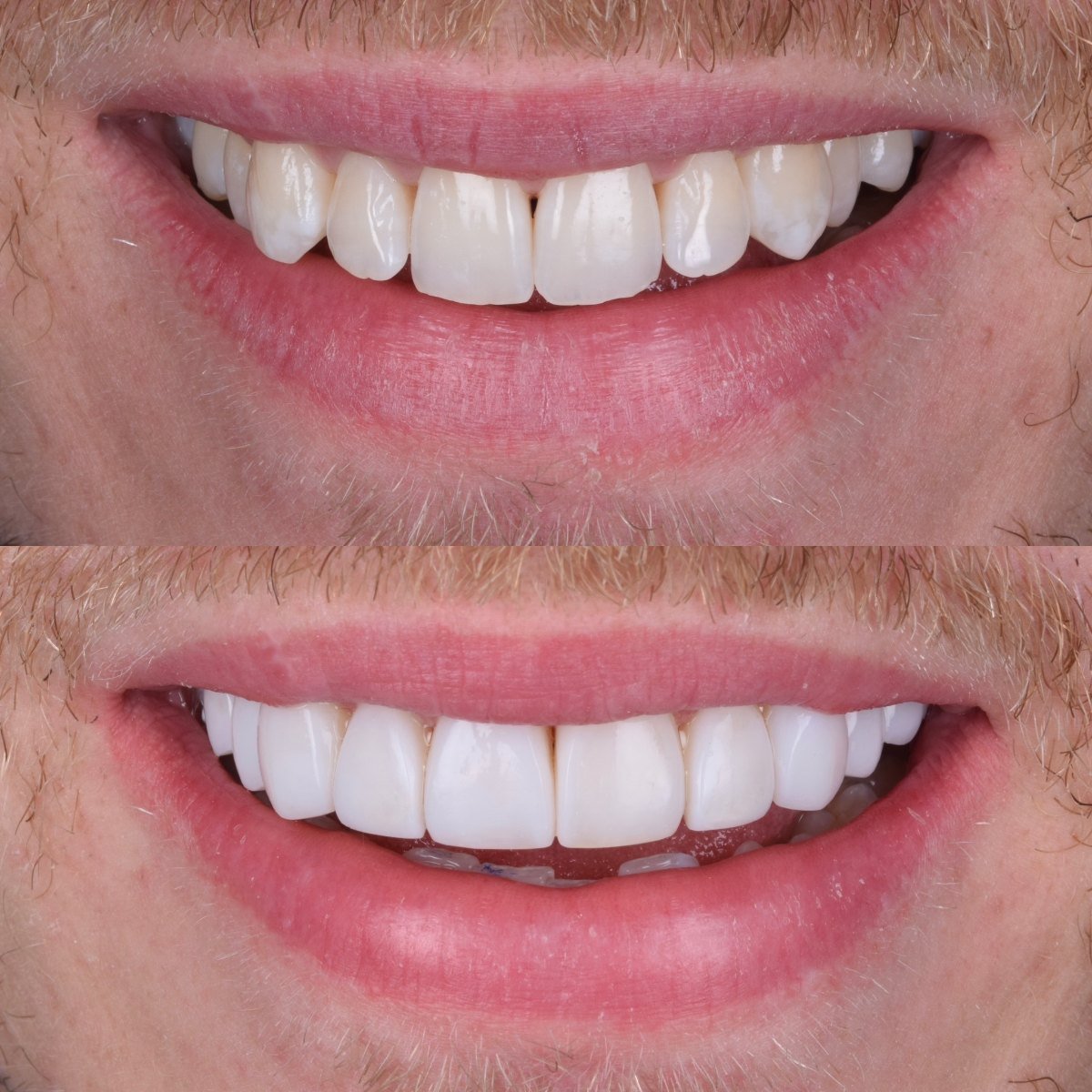 10 Composite Veneers before and after — patient of Dr Bikram Narang, cosmetic dentist in Maidenhead