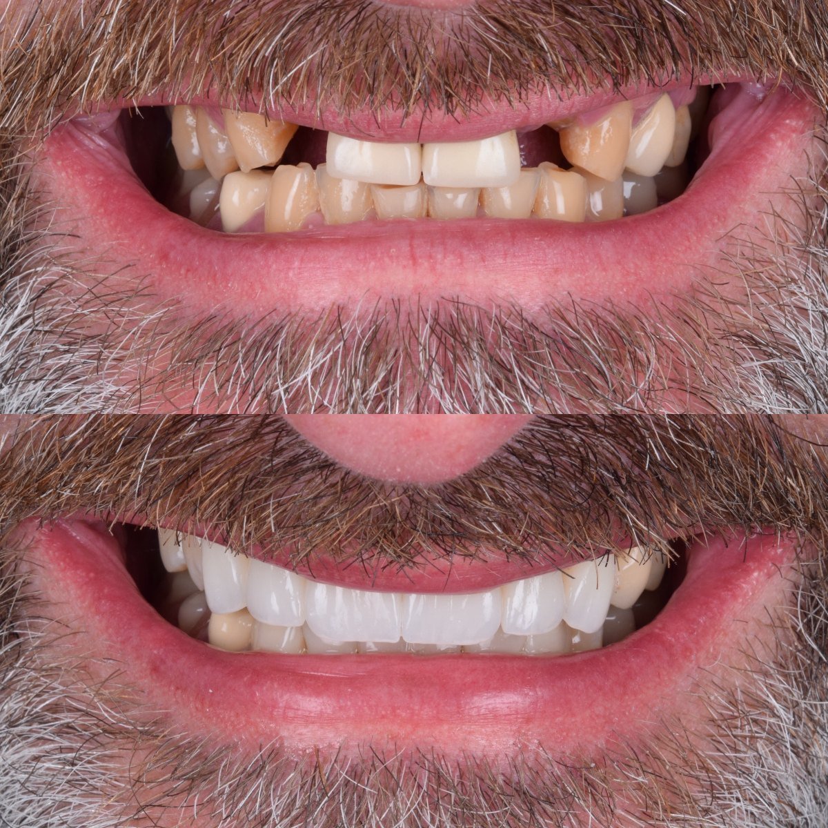 Two 3-Unit Bridges before and after — patient of Dr Bikram Narang, cosmetic dentist in Maidenhead