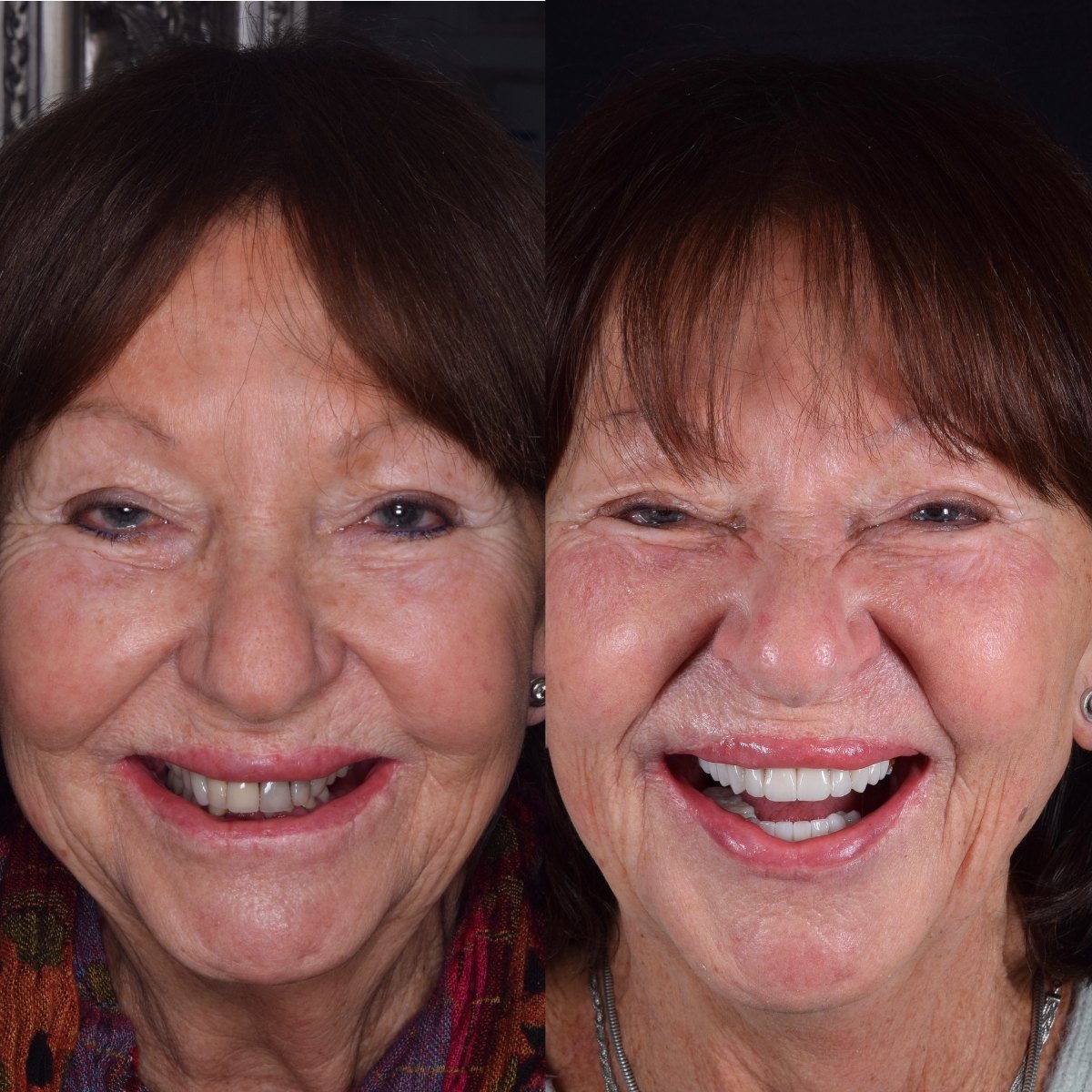 22 Crowns before and after — patient of Dr Bikram Narang, cosmetic dentist in Maidenhead